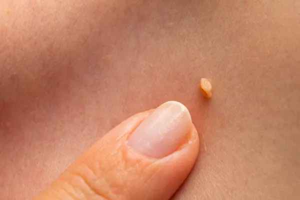 ¿Cuándo preocuparse por una verruga? Señales de alerta que no debes ignorar