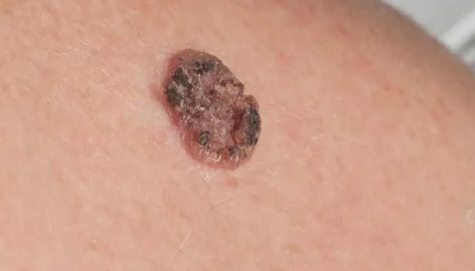 Cuál es el tipo más común de cáncer de piel y cómo tratarlo