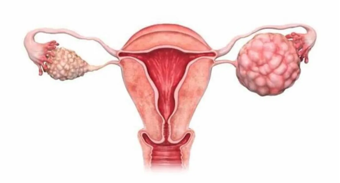 Día Mundial del Cáncer de Ovario, una fecha para reflexionar.