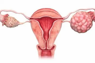 8 de mayo, Día Mundial del Cáncer de Ovario: los síntomas y el diagnóstico de una enfermedad frecuente en Argentina