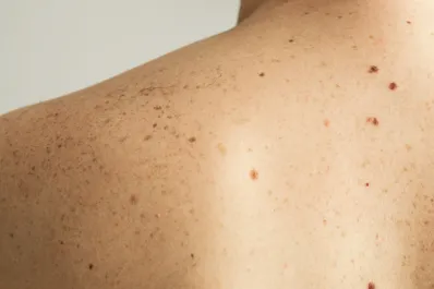 Cáncer de piel: cinco signos de alerta para consultar a un médico