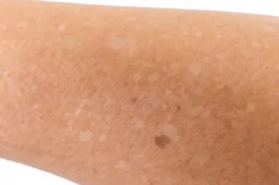 ¿Por qué salen manchas blancas en la piel?