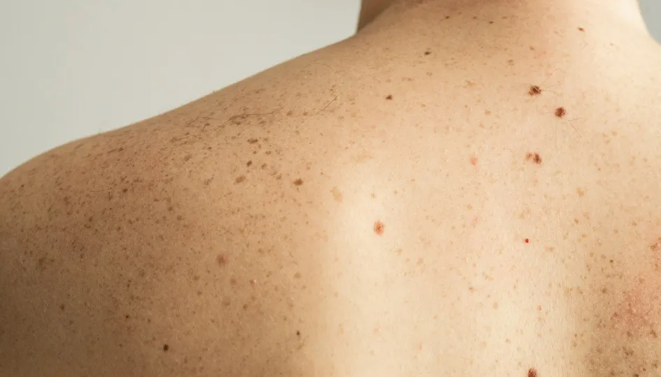 Cáncer de piel: cinco signos de alerta para consultar a un médico