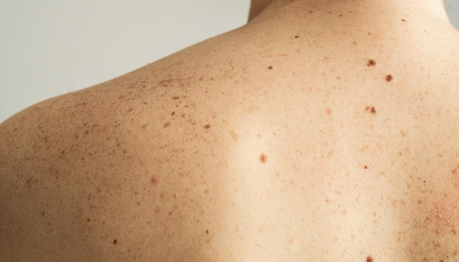 Cáncer de piel cinco signos de alerta para consultar a un médico