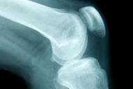 Qué provoca el cáncer de huesos y cómo detectar sus primeros síntomas