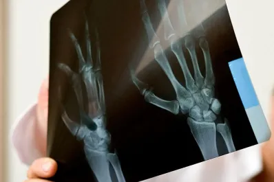 Cáncer de huesos: qué lo provoca y cómo reconocer los síntomas tempranos