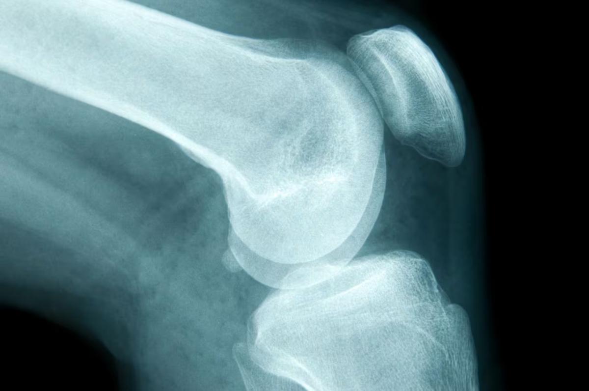 Cáncer en los huesos: cuáles son sus principales factores de riesgo y qué síntomas aparecen primero