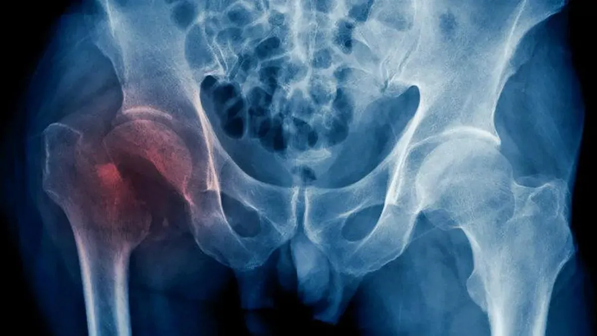 Las fracturas más frecuentes en la osteoporosis. 