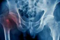 Osteoporosis: estas son las partes del cuerpo que más riesgo tienen de fracturarse