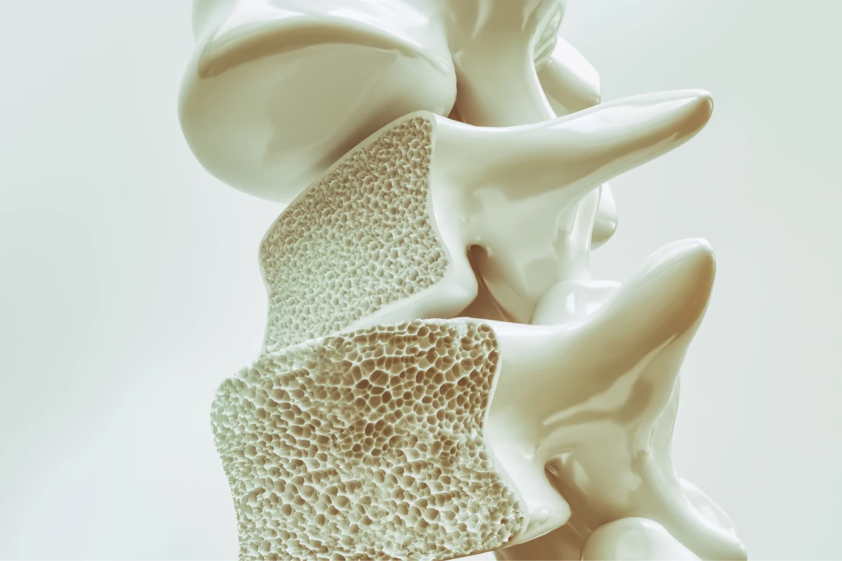 Cómo prevenir la osteoporosis en las etapas cruciales de la enfermedad. 