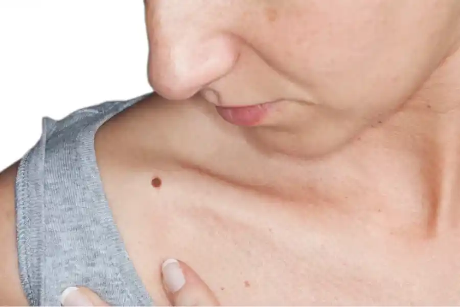 La exposición a los rayos ultravioleta (UV) del sol aumenta el riesgo de desarrollar tumores en la piel