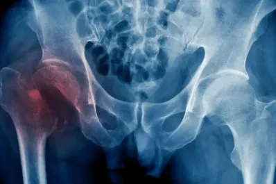 Qué comidas “roban” el calcio de tus huesos y aumentan el riesgo de osteoporosis