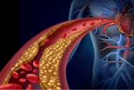 Día Mundial de la Hipertensión Arterial: cuáles son los signos de esta enfermedad que cada vez suma más adeptos