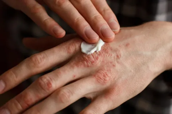 600x400_psoriasis-pustulosa-generalizada-cuales-son-sintomas-1035460-122116.webp