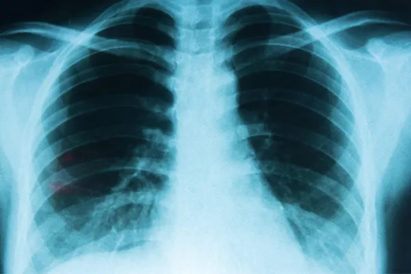 Cáncer de pulmón: cuál es el fármaco autorizado por la Anmat que previene las recaídas