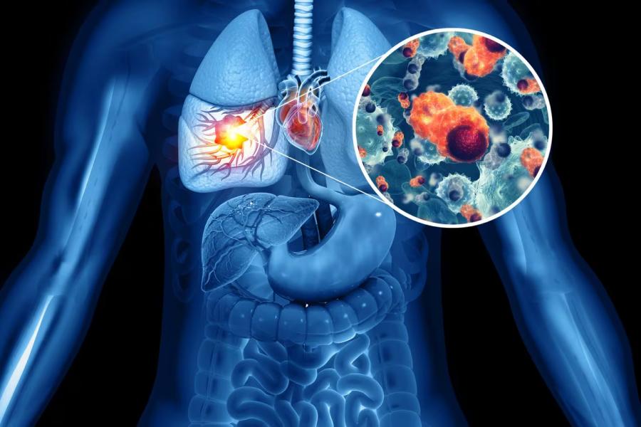 El cáncer de pulmón es uno de los tumores más frecuentes, del que se diagnostican más de 12.000 casos nuevos al año en Argentina.