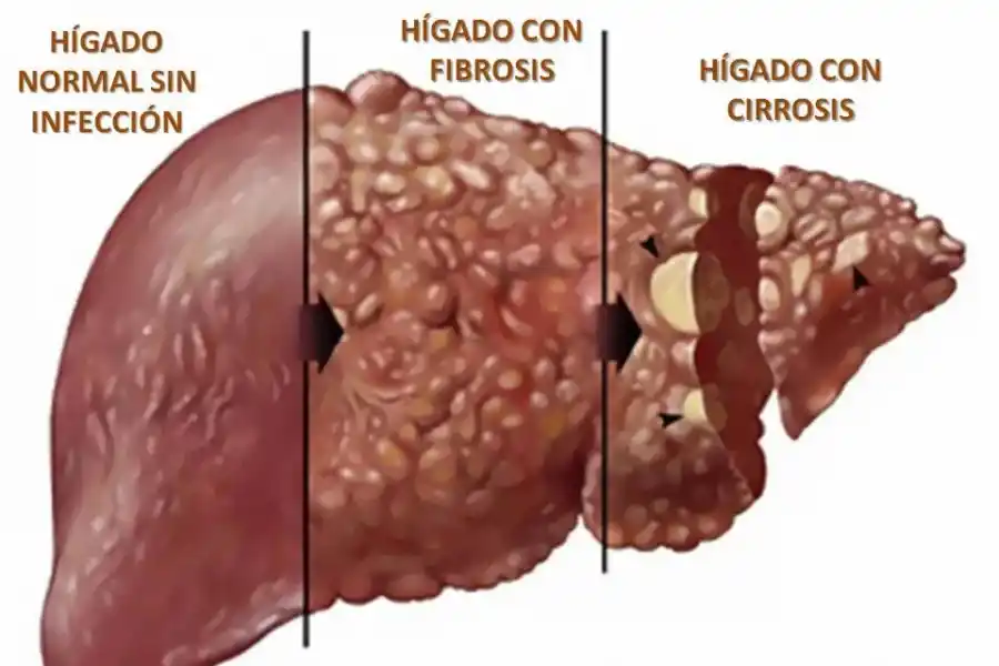 Fases de un hígado enfermo.