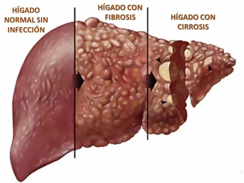 Fases de un hígado enfermo.