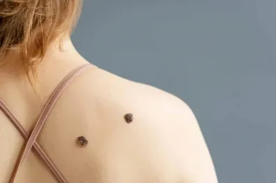 Día Mundial del Melanoma: quiénes están en riesgo y por qué es tan peligroso