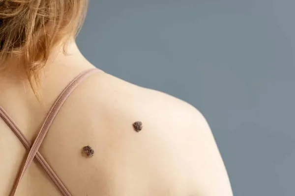 Día Mundial del Melanoma: quiénes están en riesgo y por qué es tan peligroso