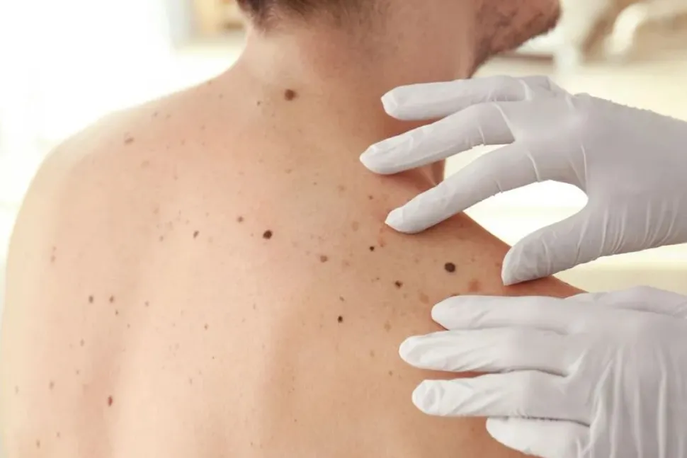 ¿Cómo saber si tienes un melanoma?: cinco síntomas que debes conocer 