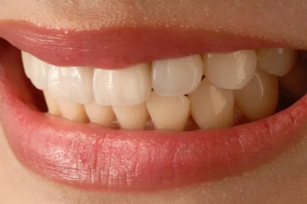 Qué alimentos debes evitar para no manchar los dientes