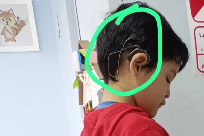 Un niño de cuatro años perdió su implante coclear en Tucumán y piden ayuda para recuperarlo