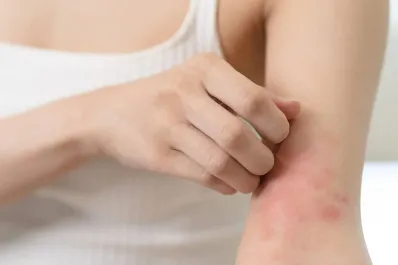 La dermatitis atópica afecta a entre el 15% y el 25% de niños y adolescentes