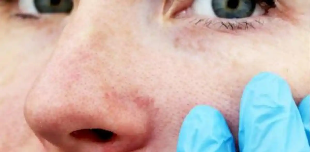 La piel activa sus mecanismos de defensa para protegernos del frío. 