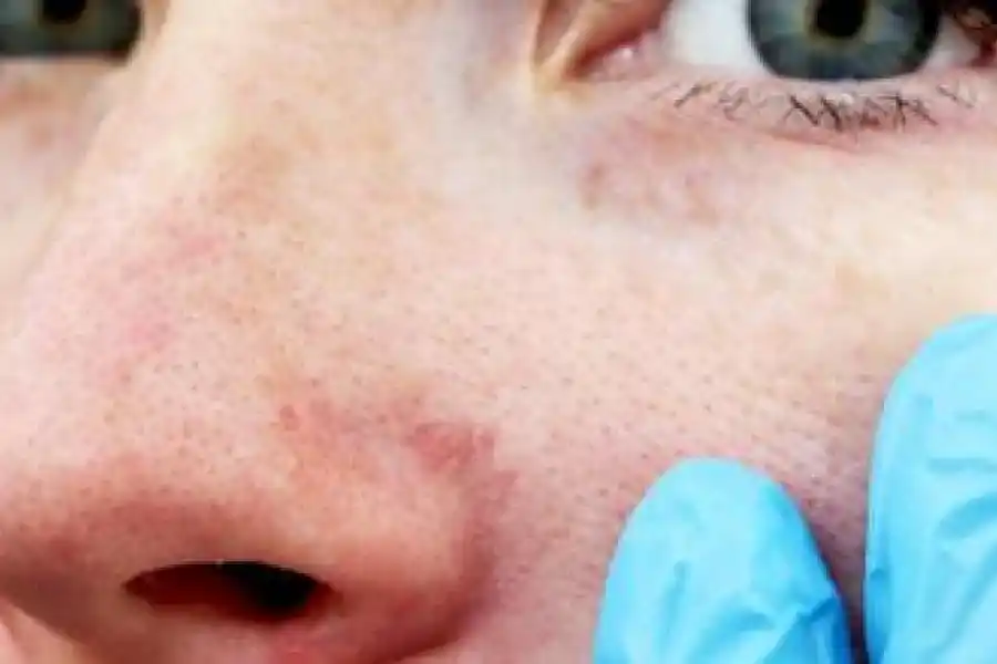 La piel activa sus mecanismos de defensa para protegernos del frío. 