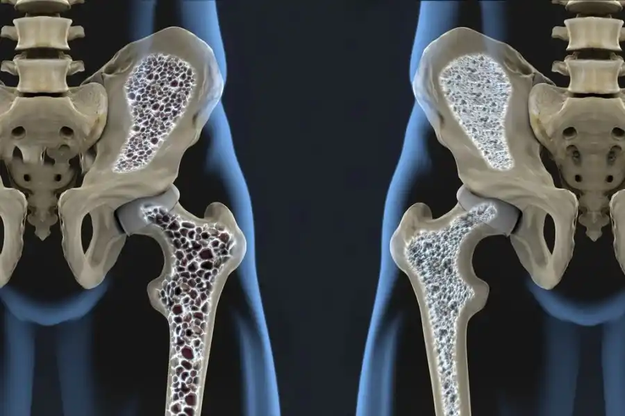 La vitamina D ayuda a prevenir la osteoporosis. 