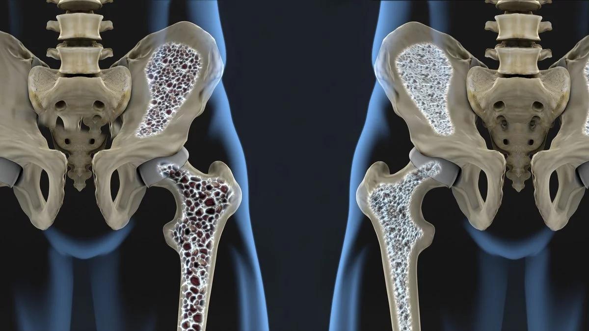 La vitamina D ayuda a prevenir la osteoporosis. 