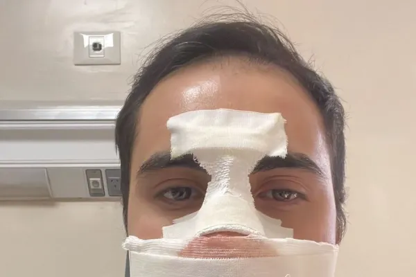 Navarro bancó un combate con el tabique nasal fracturado