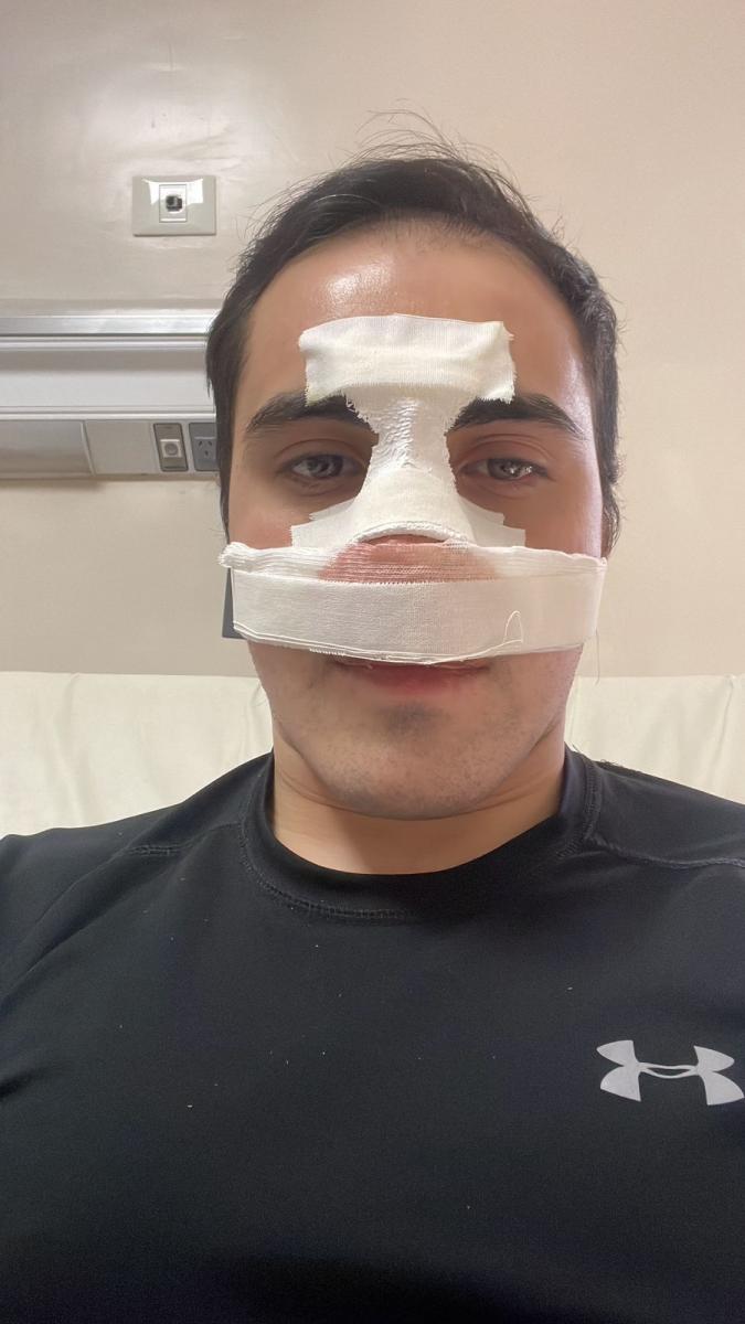 Navarro bancó un combate con el tabique nasal fracturado