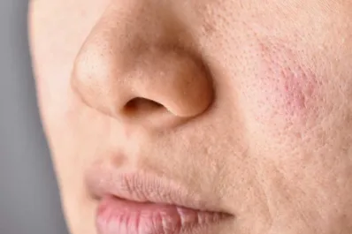 ¿Cómo el estrés perjudica la salud de tu piel y cómo podés cuidarla?