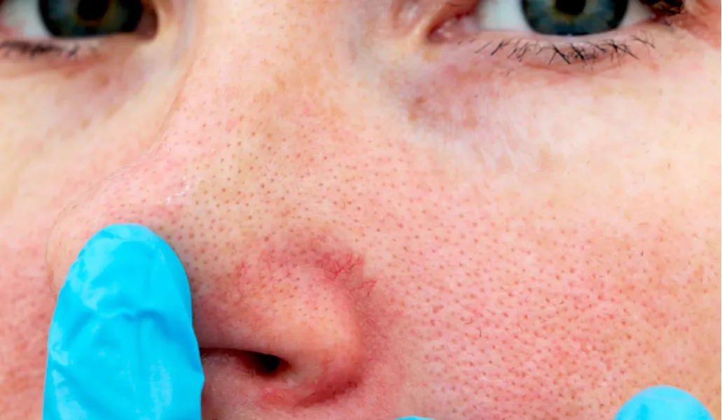 Las aletas nasales pueden verse afectadas con el frío.