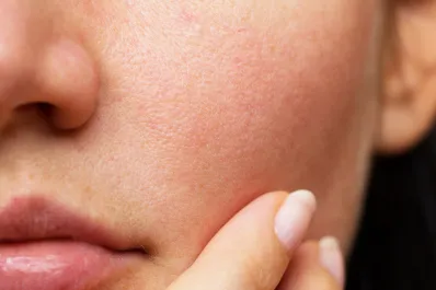 ¿Por qué el frío hace que la piel se nos seque?