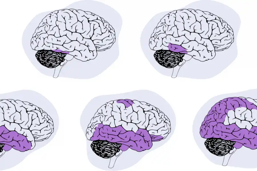 En las distintas etapas del Alzheimer, nuevas partes del cerebro se ven comprometidas.