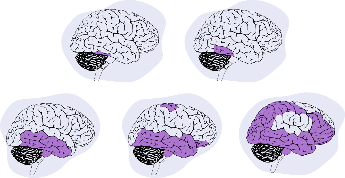 En las distintas etapas del Alzheimer, nuevas partes del cerebro se ven comprometidas.
