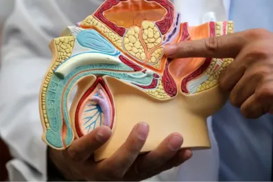 Cáncer de próstata: ¿es posible prevenirlo?