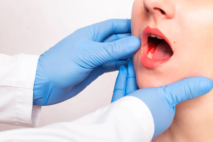 El cáncer de boca tiene dos principales factores de riesgo