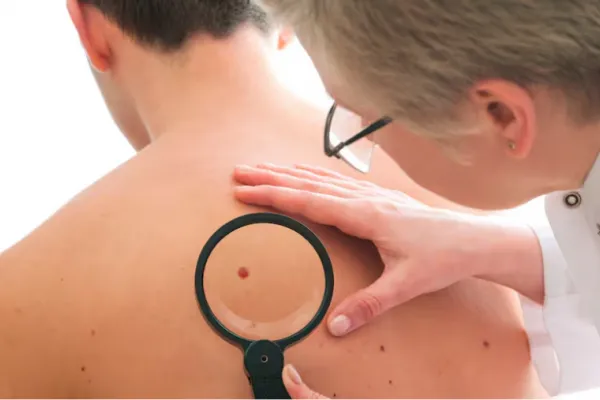 Cáncer de piel: ¿cuál es el tipo más común y por qué es tan difícil detectarlo?