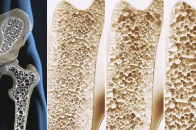 Cuál es la proteína que podría fortalecer los huesos y prevenir la osteoporosis