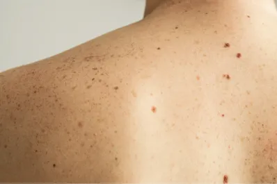 Cáncer de piel: ¿cómo es la regla ABCDE que es clave para detectarlo a tiempo?