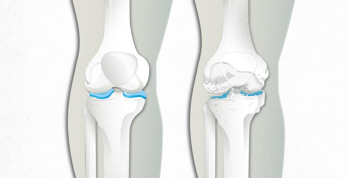 En la artrosis, el cartílago de las articulaciones se desgasta, provocando dolor.