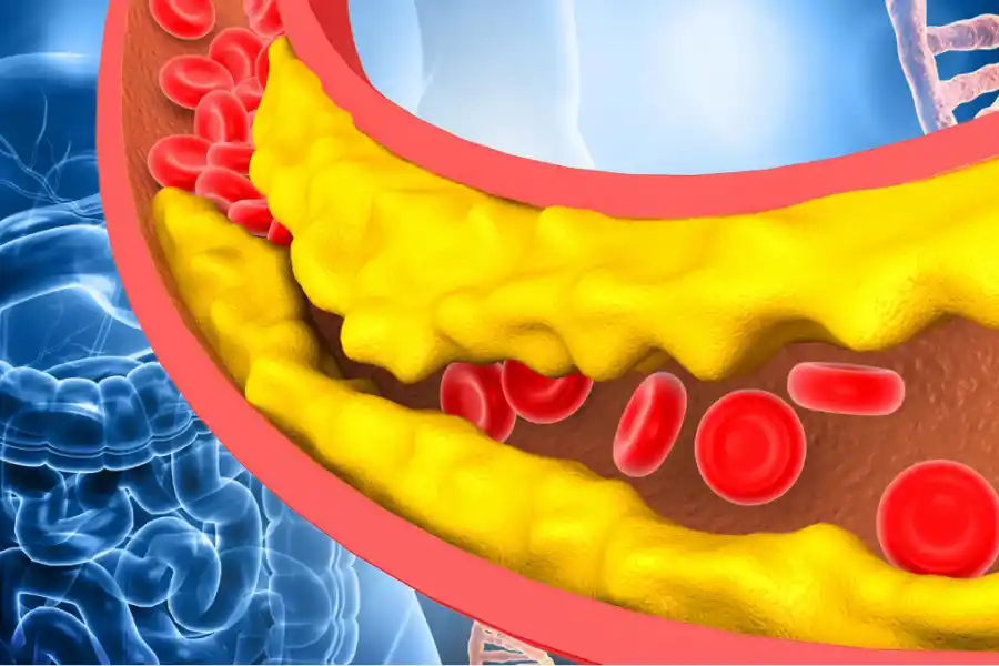 El colesterol malo se acumula en las arterias y forma placas