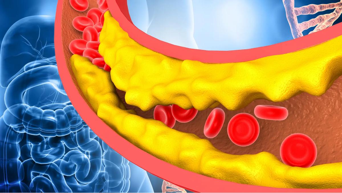 El colesterol malo se acumula en las arterias y forma placas
