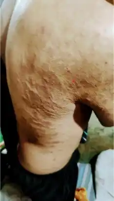 SARNA. Sufren infecciones varias. asdfasdf asdfasdfasdfasdf