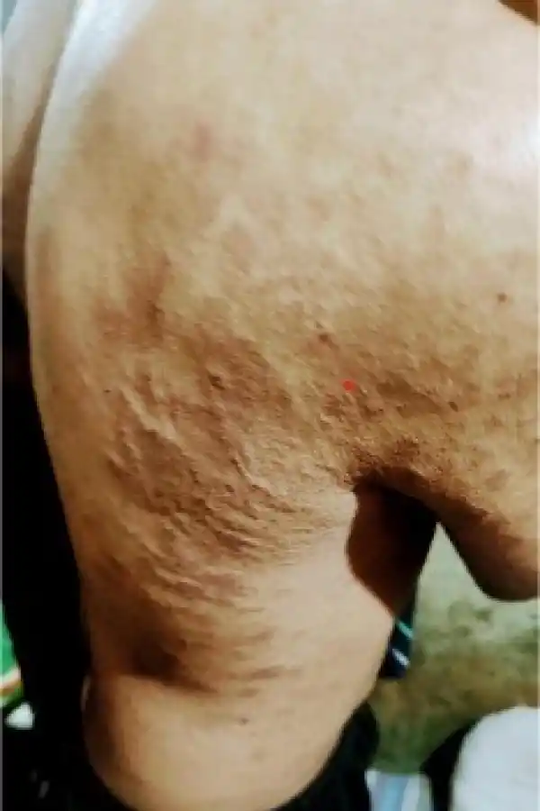 SARNA. Sufren infecciones varias. asdfasdf asdfasdfasdfasdf