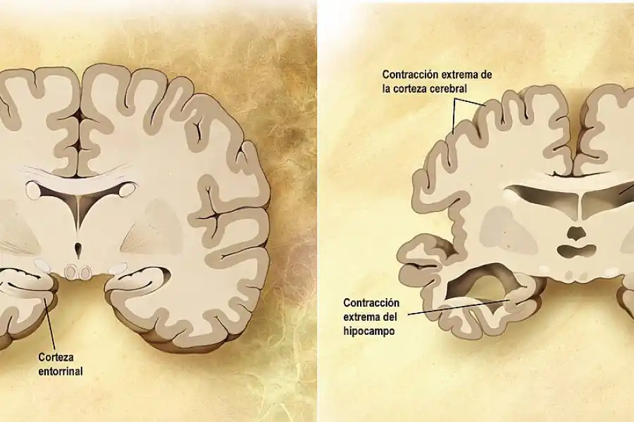 ¿Cuáles son las causas del alzheimer?